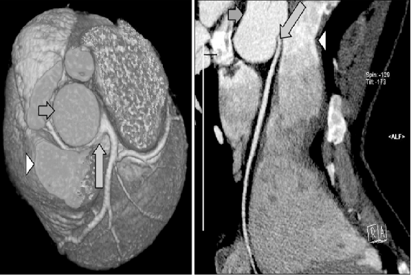 Coronary Artery Angiography