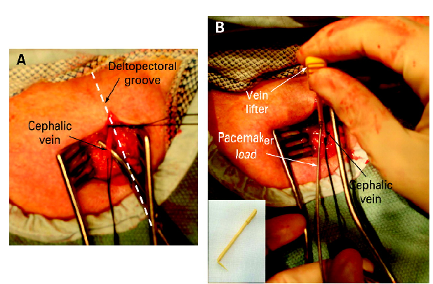 Permanent Pacemaker Implantation