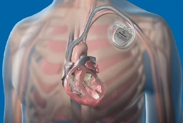 ICD AND CRT
