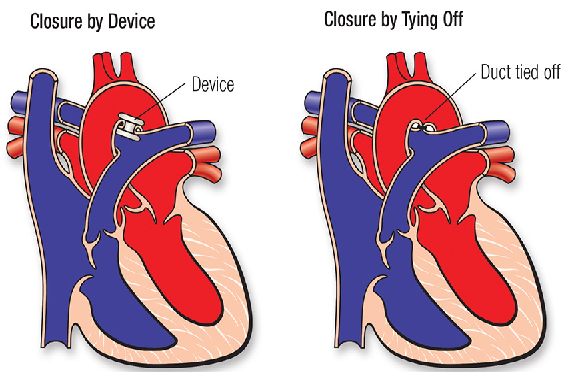 ASD VSD PDA DEVICE CLOSURE