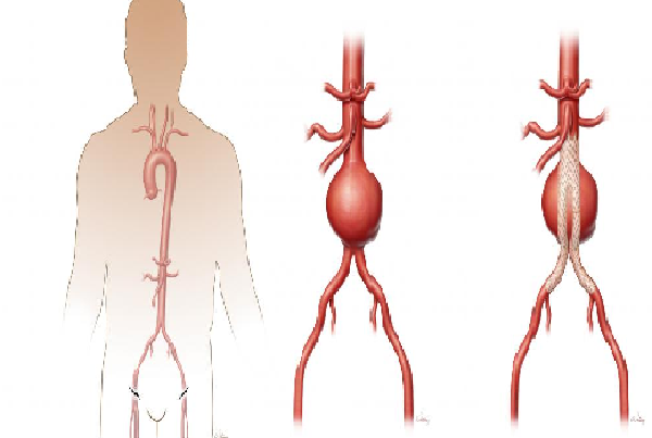 Aortic Aneurysm Repair