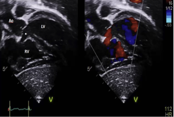 Pediatric Echo